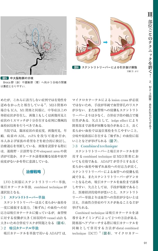 改訂2版 血栓回収療法Technical Tips：治療の引き出しを増やす！／手技