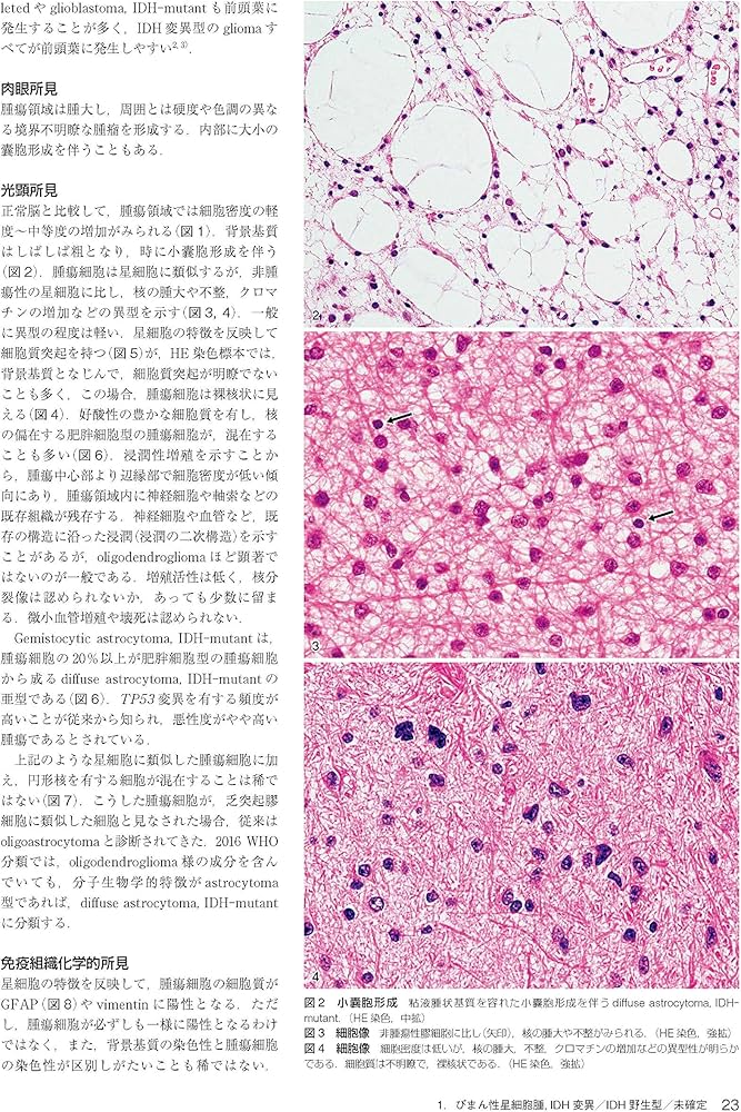 Amazon.co.jp: 脳腫瘍臨床病理カラーアトラス 第4版 : 日本脳腫瘍病理