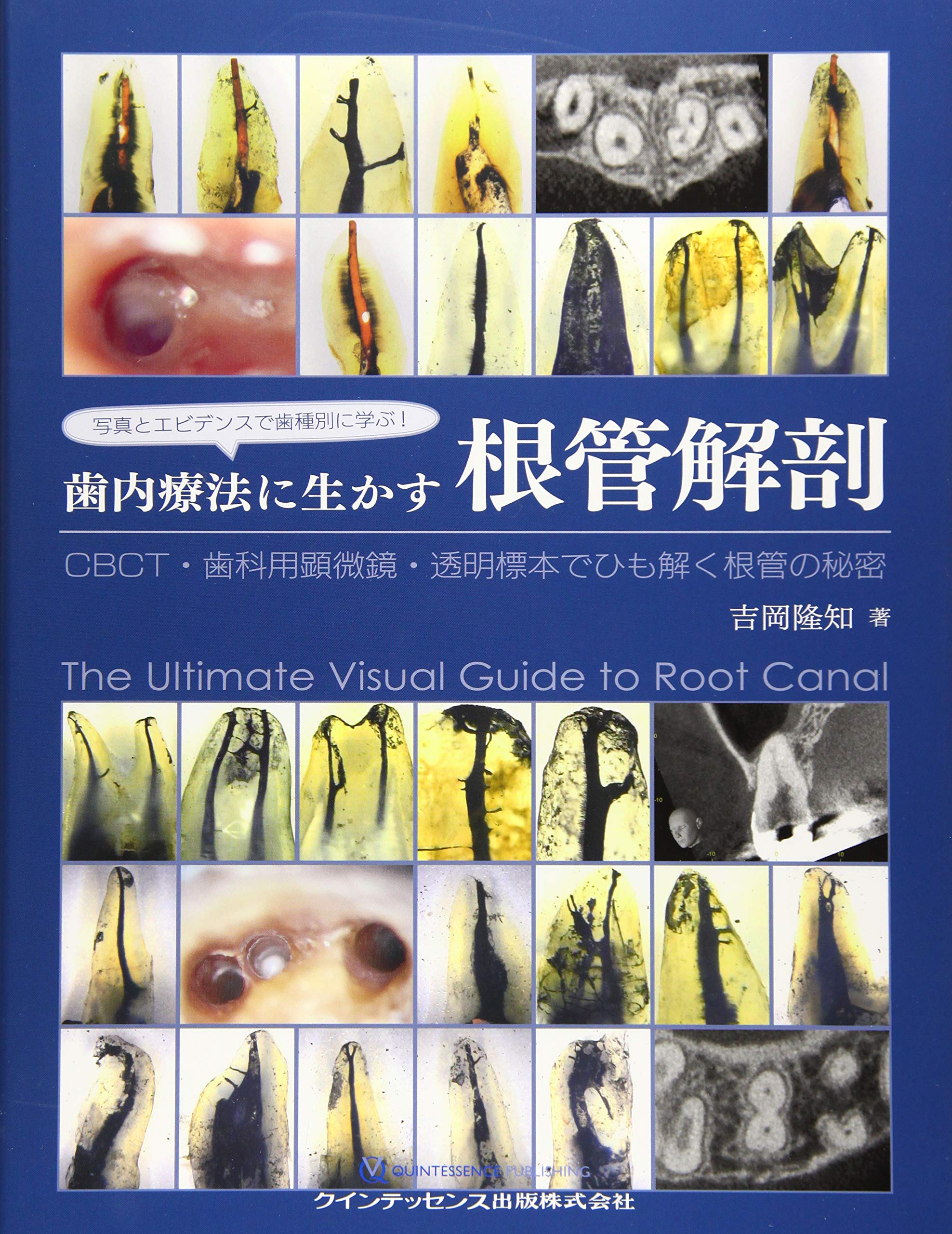 写真とエビデンスで歯種別に学ぶ! 歯内療法に生かす根管解剖 | 吉岡 隆