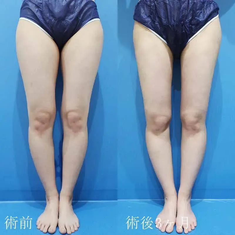 太もも・お尻の脂肪吸引 | 名古屋栄の美容整形外科・美容皮膚科は