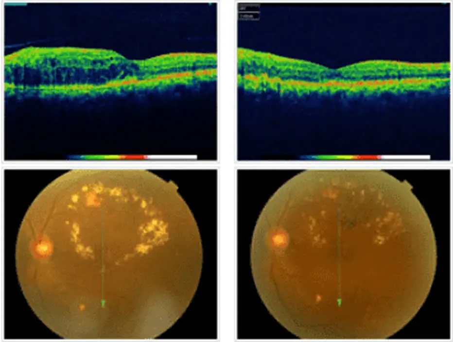 網膜硝子体手術｜診療・手術案内｜森井眼科医院