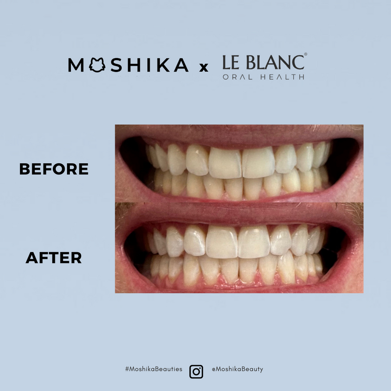 Moshika X LE BLANC Teeth Whitening Kit – Moshika Beauty