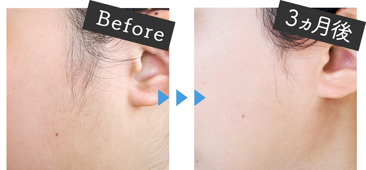 ミュゼの家庭用光美容器ってほんとにムダ毛ケア効果あるの？3ヶ月体験