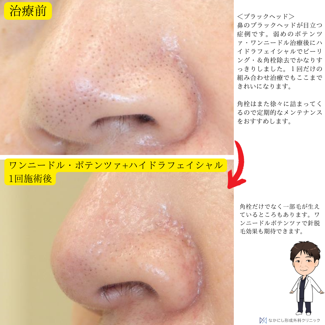 ブラックヘッドにはワンポテ＆ハイドラ！｜なかにし︎形成外科