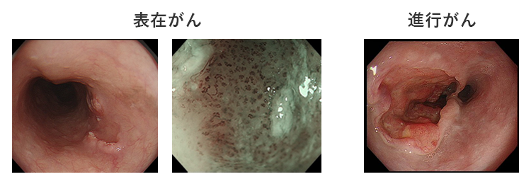 食道がん｜大阪国際がんセンター
