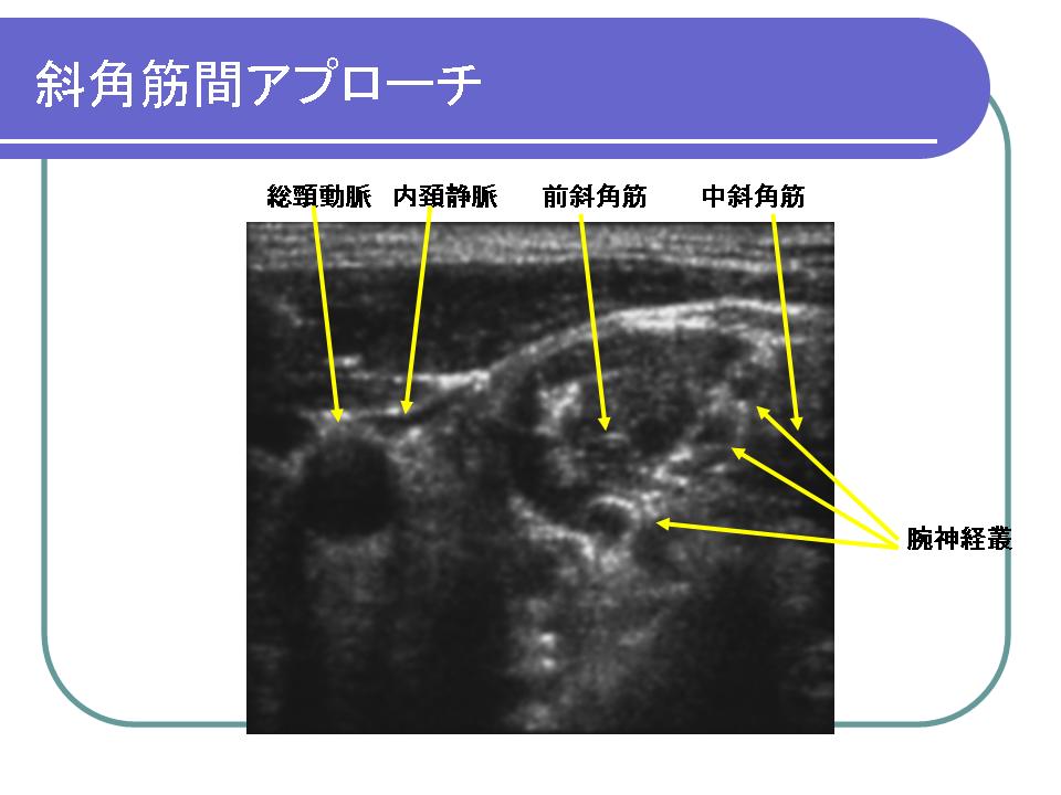 超音波ガイド下末梢神経ブロック入門(4) : 電脳麻酔ブログ