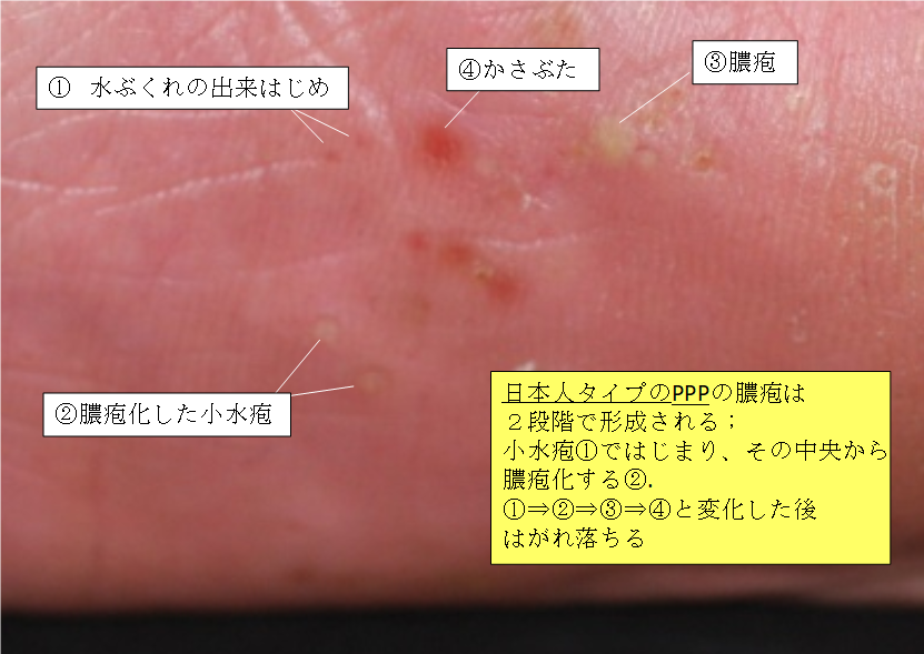 掌蹠膿疱症とは | 掌蹠膿疱症コミュニティのサイト