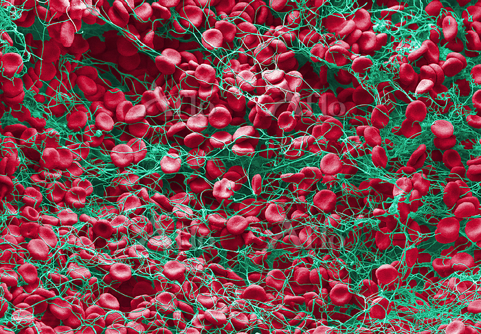 Red blood cells (erythrocytes) in a fibrin mesh, coloured scanning