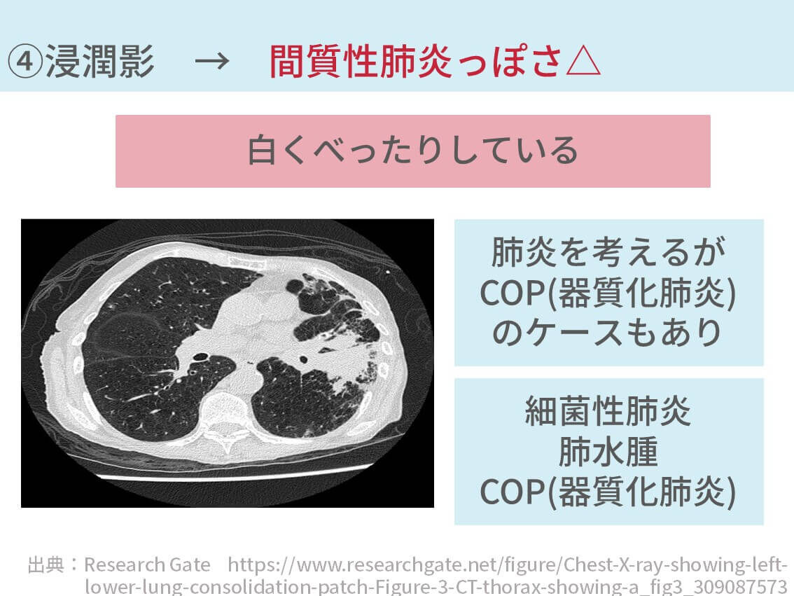 間質性肺炎を診断する方法【悲報：実はめちゃ難易度たかいです】※医療