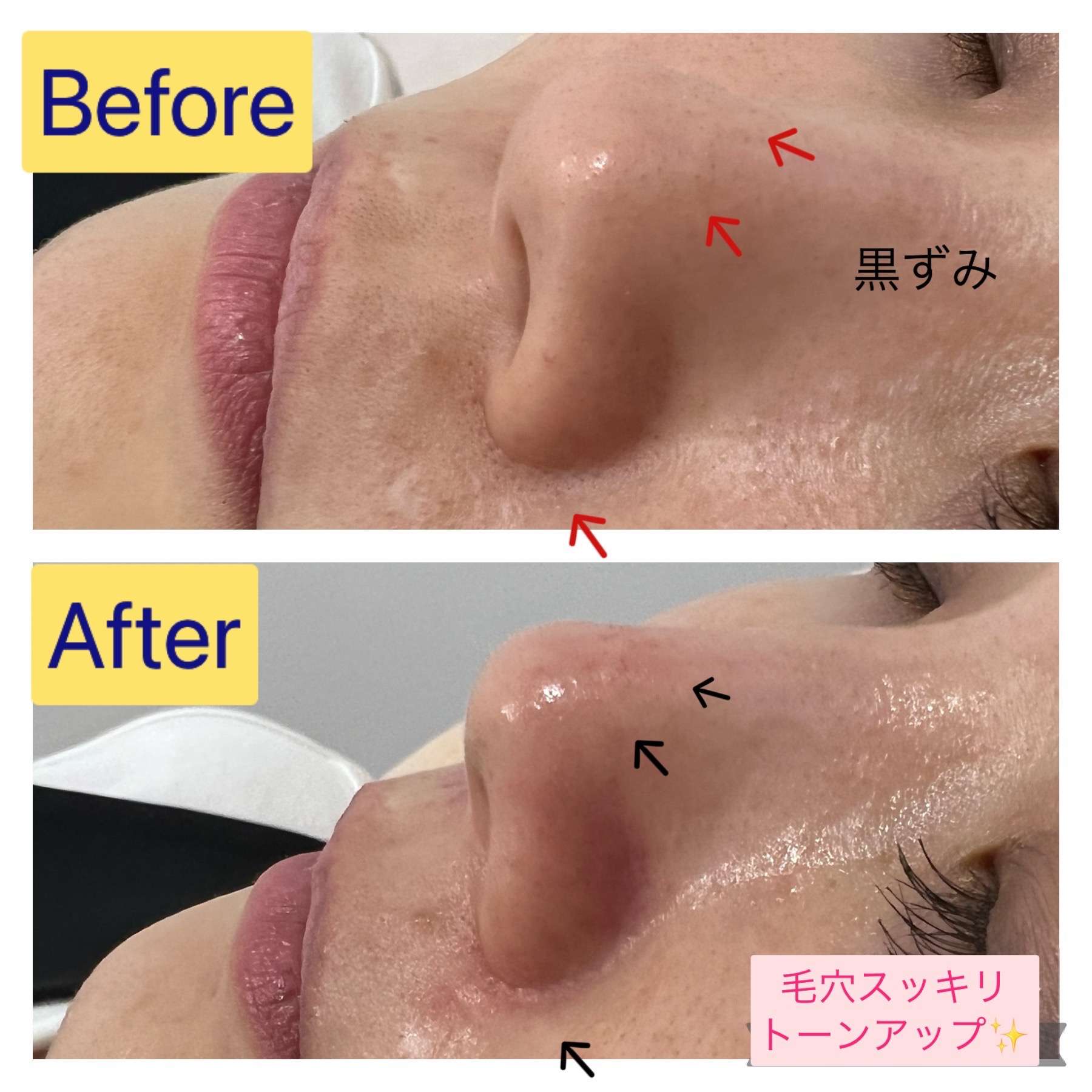 毛穴洗浄ハイドロスプラッシュで角栓汚れと黒ずみ毛穴を除去|兵庫