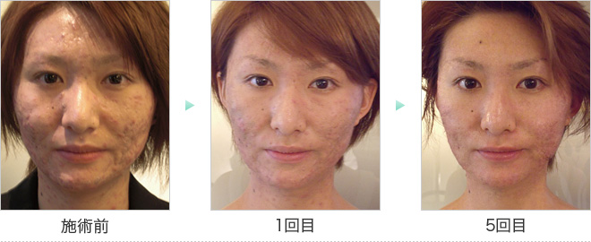 2Bバイオトリートメント｜東京・福岡・鹿児島でブラジリアンワックスや