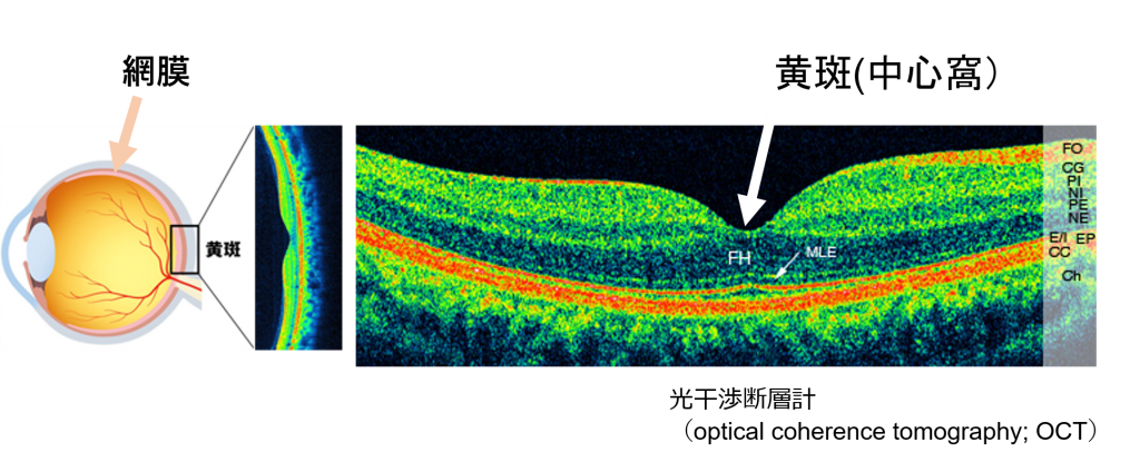 加齢黄斑変性【桜ケ丘安田眼科】可児市の眼科