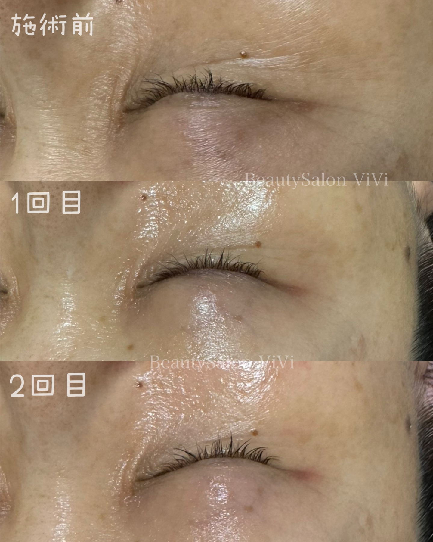 最初は週1で5回継続してほしい理由 - フェイシャルエステ・毛穴洗浄