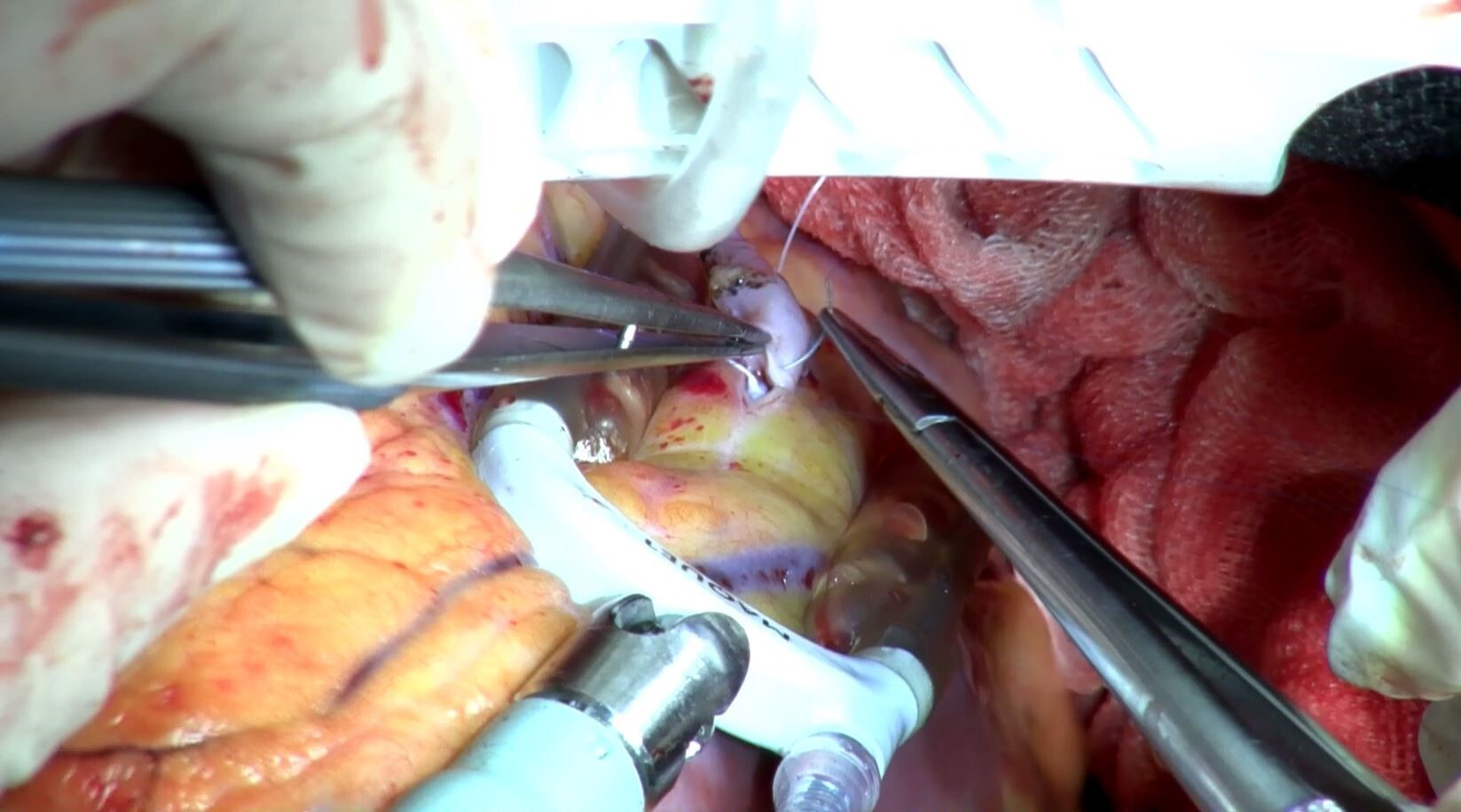 心拍動下冠動脈バイパス術（OPCAB) | 表示確認 | 病院の特色 | 社会