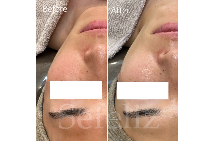 ワイコ水光ピール効果写真紹介！たった1回で想像以上の透明感