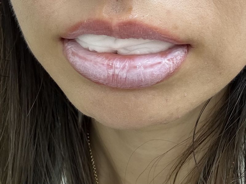 ローマピンク唇｜施術1回でここまで変化！実際の症例をご紹介