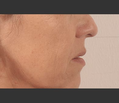 オキシジェネオ（Oxy Geneo）』角質除去、美容成分浸透、酸素発生の3