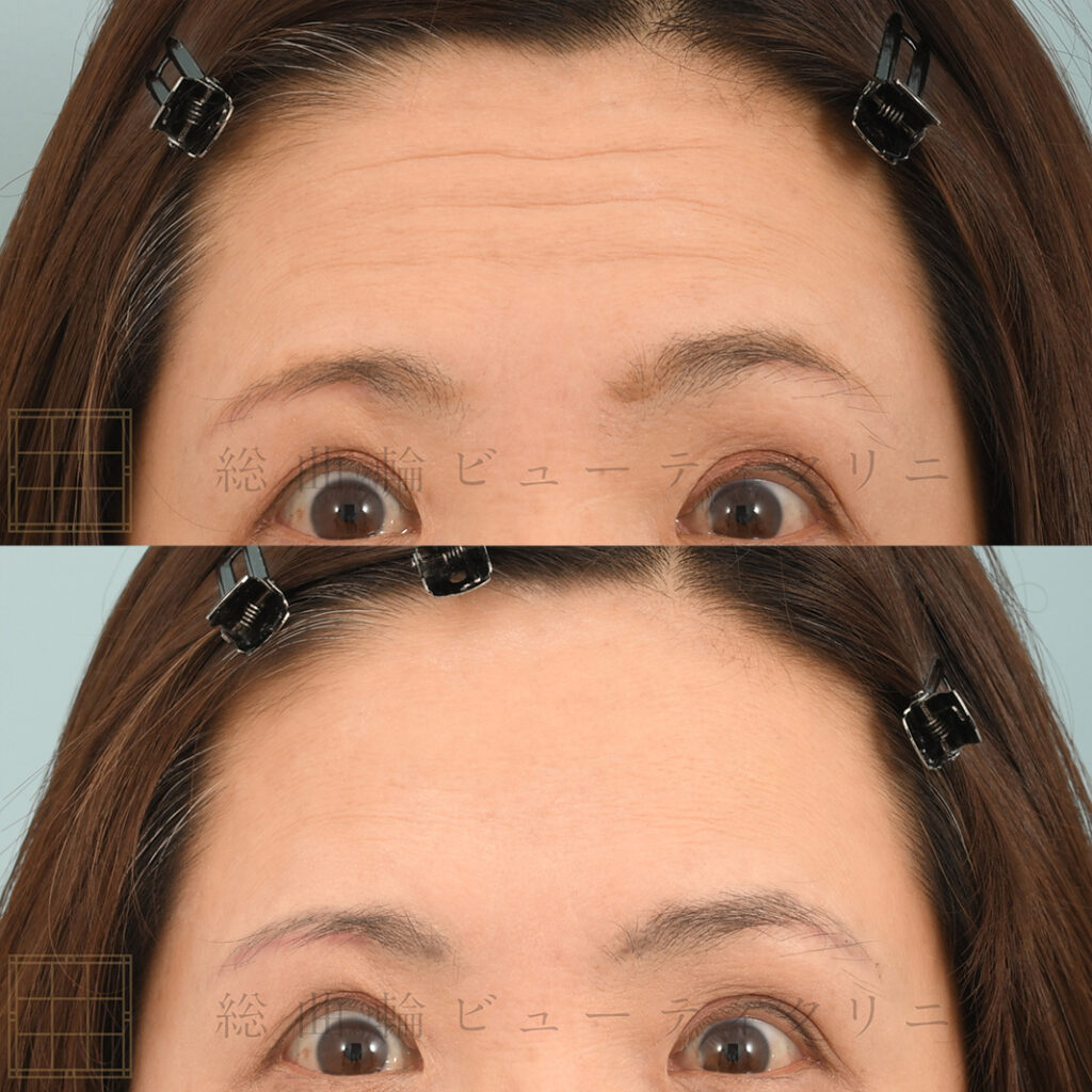 コラム｜tax - ボツリヌストキシン注射、ヒアルロン酸治療は総曲輪