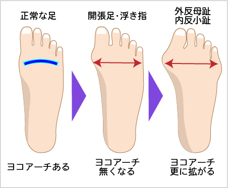浮き指 開張足 内反小趾 インソール サポーター