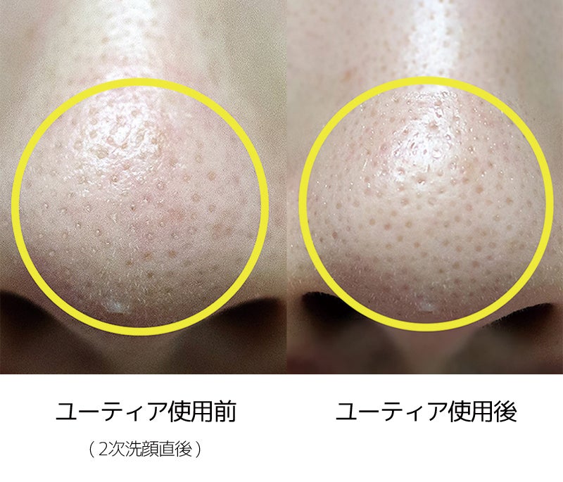 角栓・黒ずみ！毛穴をすっきりケア！リアルなアクアピーリング機で確実