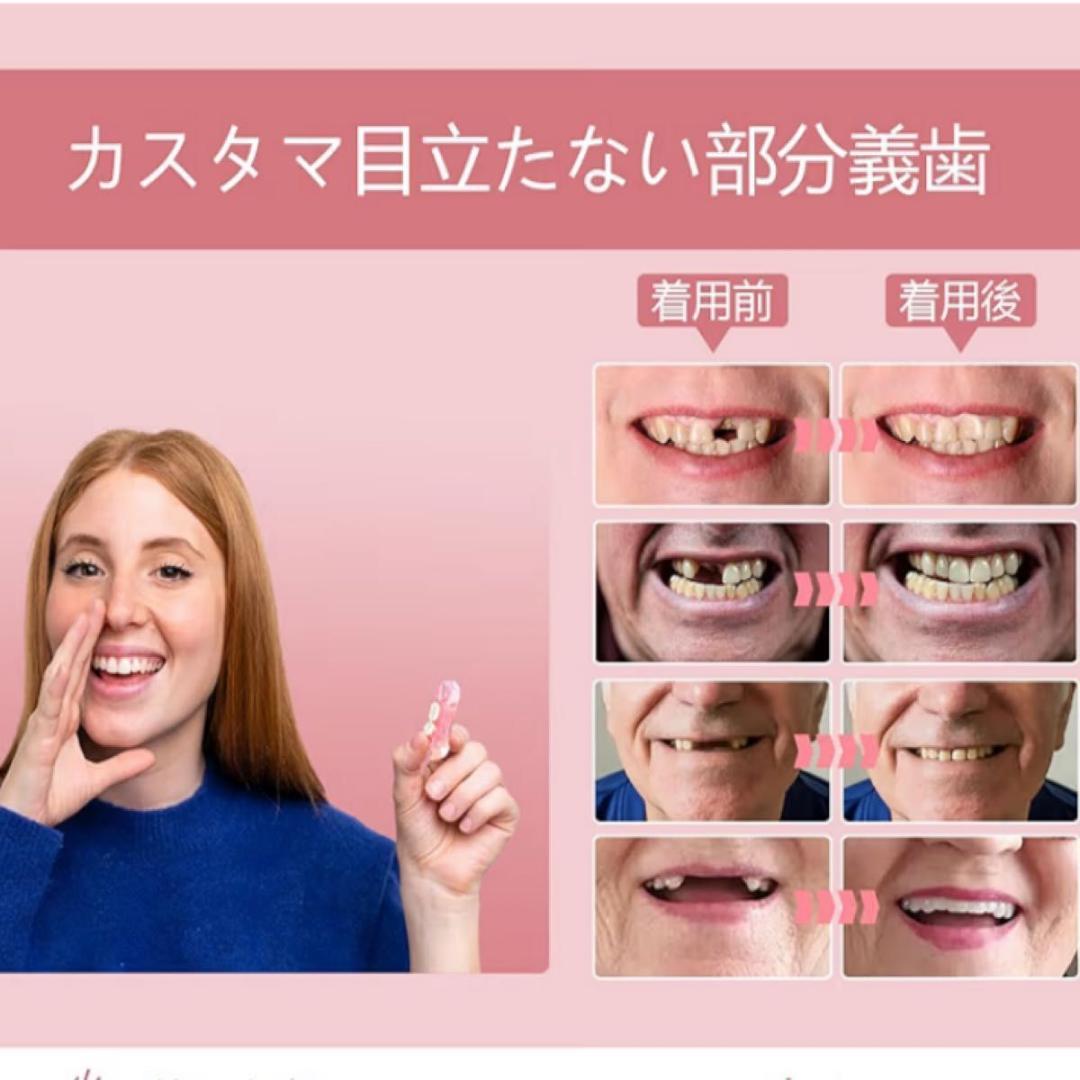 セルフフィッティング 仮歯 歯型採取キット付 カスタマイズ 1本 欠損