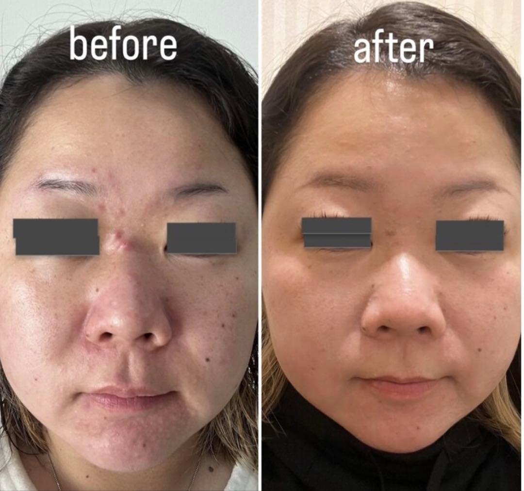 ハーブピーリング 剥離あり 皮向けあり 10回分→10g - メルカリ