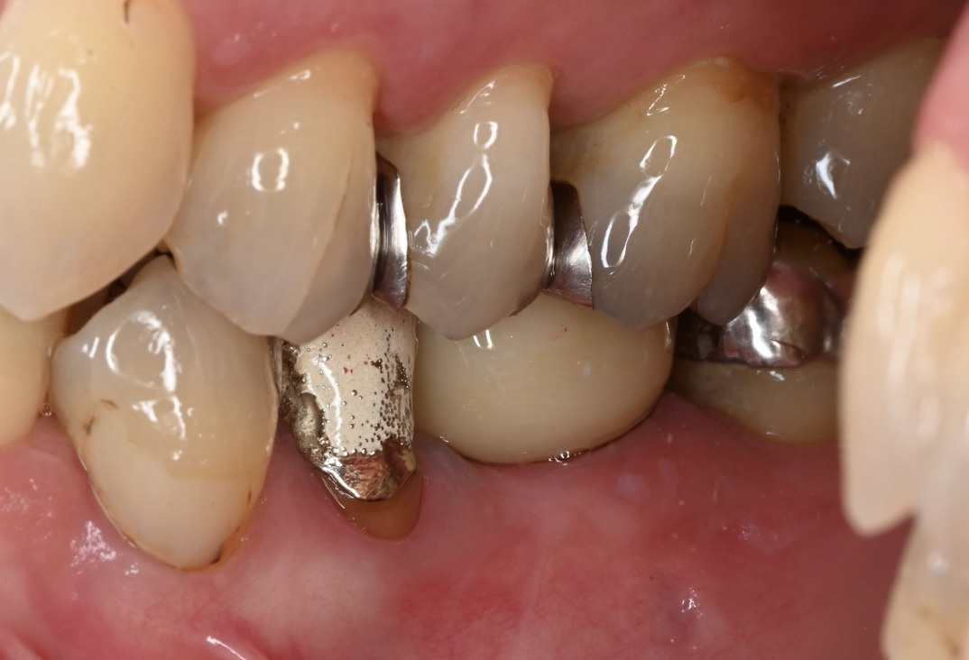 インプラントによる咬合回復 | 江東区北砂の歯医者【砂町北歯科】歯周